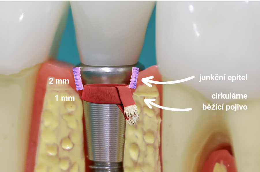 Který implantační systém mají zubní technici nejraději?