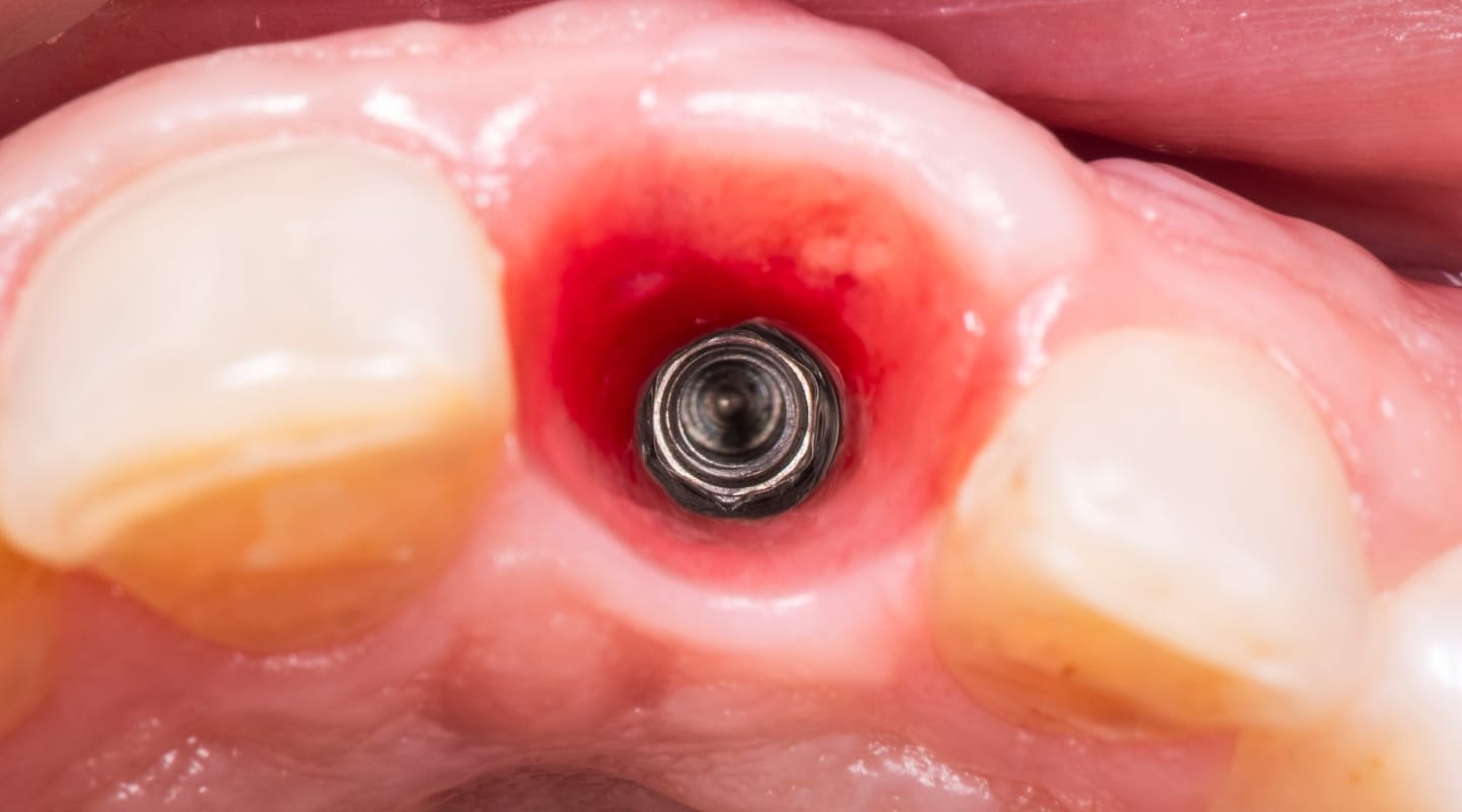 S implantátem na věčné časy - Optimální integrace implantátu v kosti i měkkých tkáních - Díl 1.