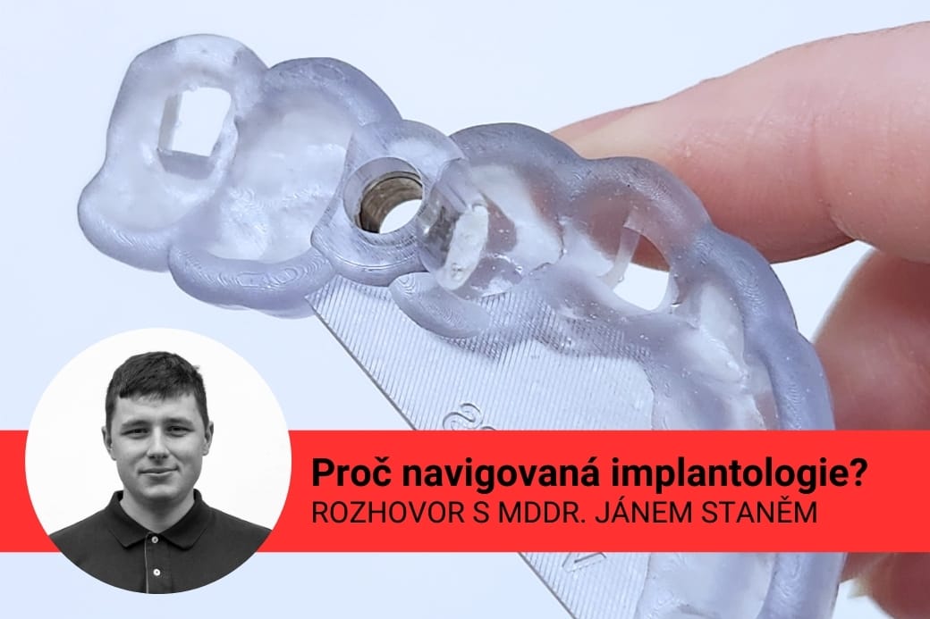 Navigovaná implantologie se zaměřením na imediátní implantaci - rozhovor se stomatologem